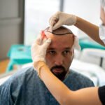 زراعة الشعر في تركيا